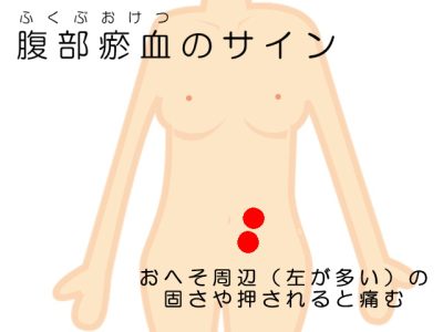 腹部瘀血のサイン（イラスト）
おへそ周辺（左が多い）の固さや押されると痛む
